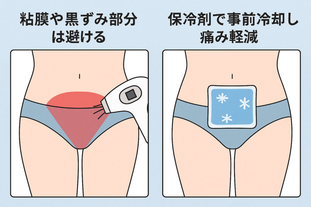 VIO脱毛のやり方